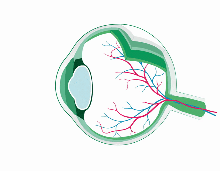 Animazione clinica — cheratocono e forma conica della cornea